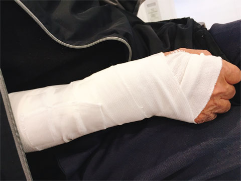 高齢者の骨折